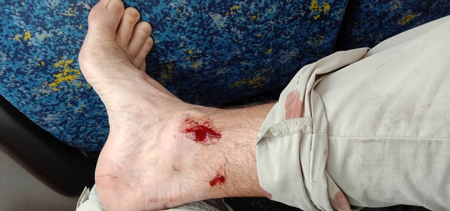 Leech bites on Jono's leg during the Great North Walk.